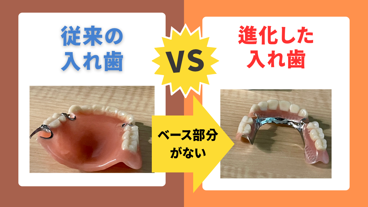 インプラントを検討中の方へ/進化している「入れ歯」という、もう一つの選択肢をご存じですか？/さいたま市入れ歯の専門医