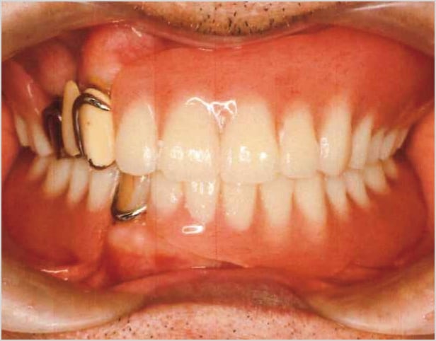 【症例1】70歳男性治療後