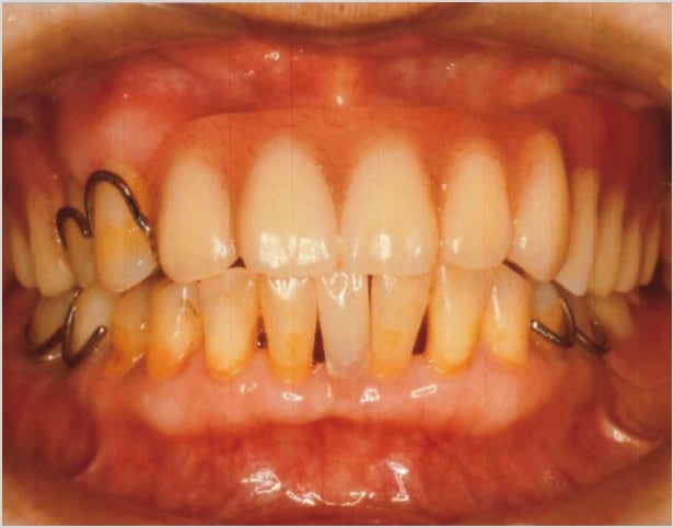 【症例3】70代女性治療後