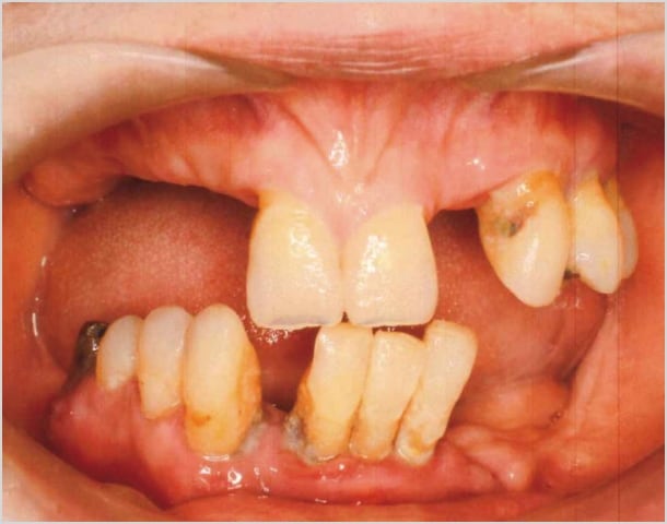 【症例5】70代女性治療前