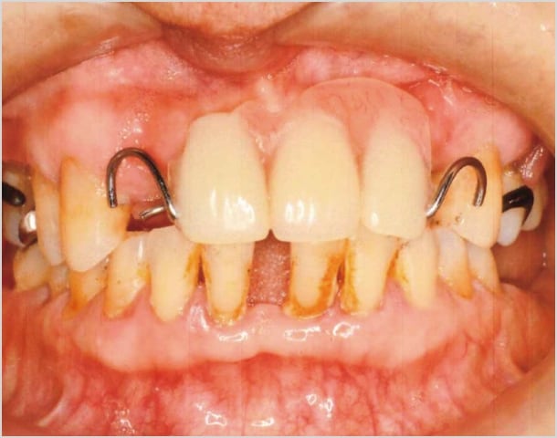 【症例3】70代女性治療前