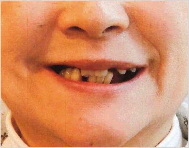 【症例5】70代女性治療前2