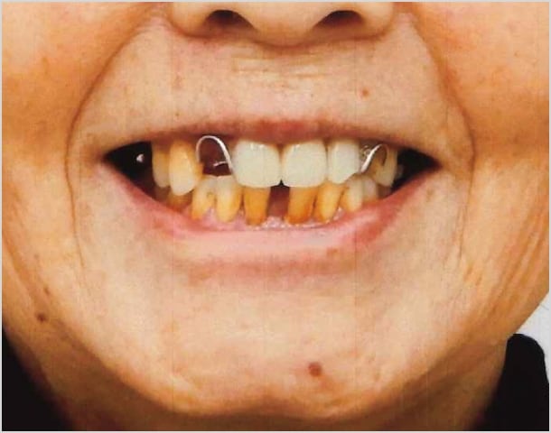 【症例3】70代女性治療前2