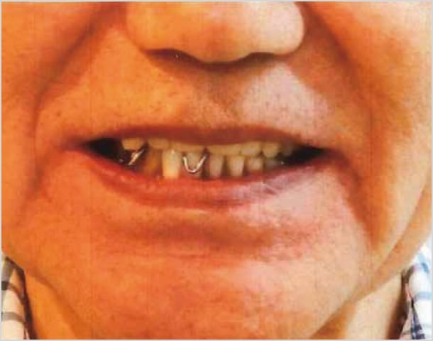 【症例1】70歳男性治療前2