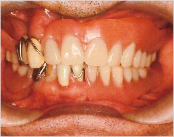 【症例1】70歳男性治療前