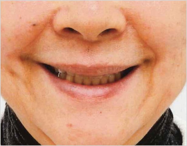 【症例5】70代女性治療後2