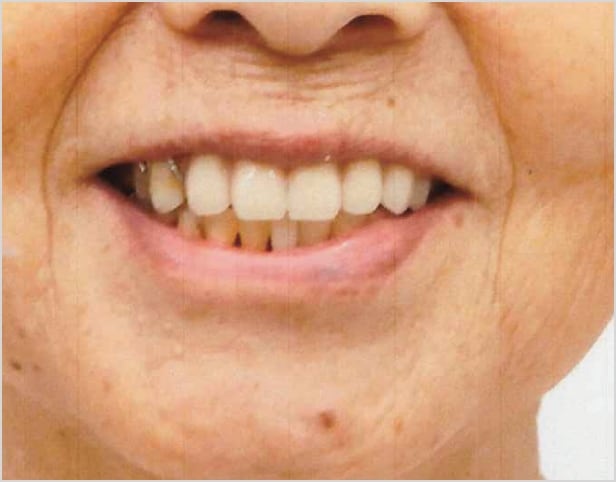 【症例3】70代女性治療後2