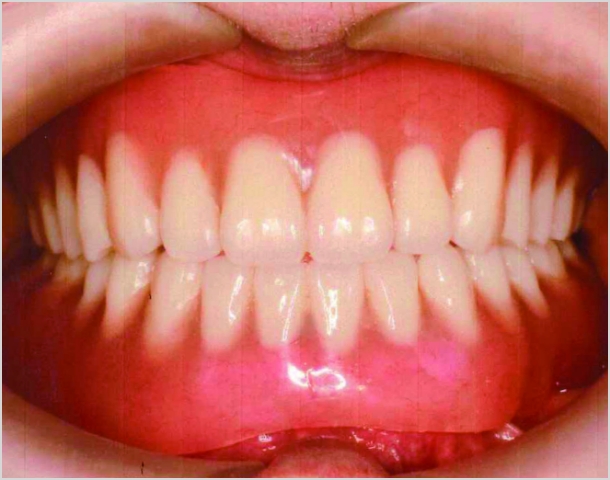 【症例8】60代女性治療後