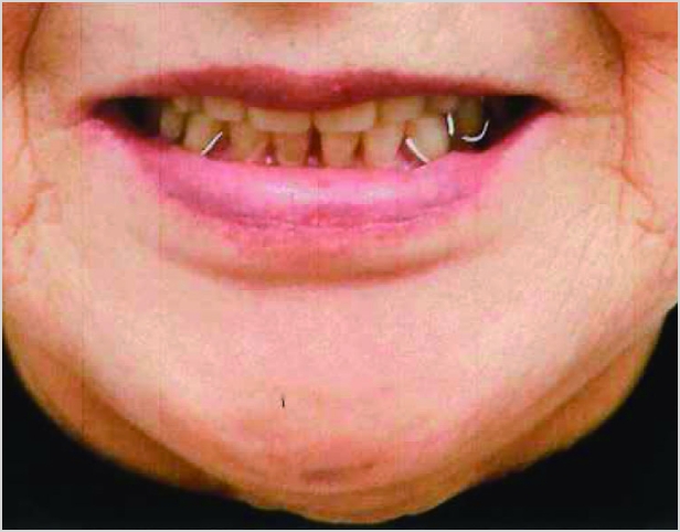 【症例6】70代女性治療後2