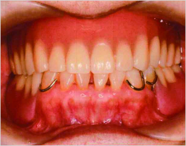 【症例6】70代女性治療後