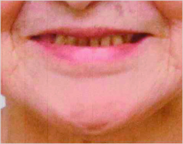 【症例6】70代女性治療前2