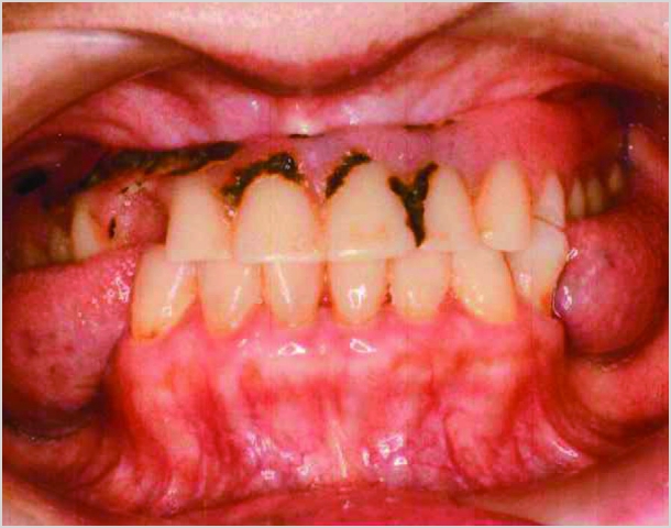 【症例6】70代女性治療前