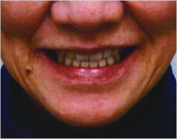 【症例8】60代女性治療後2